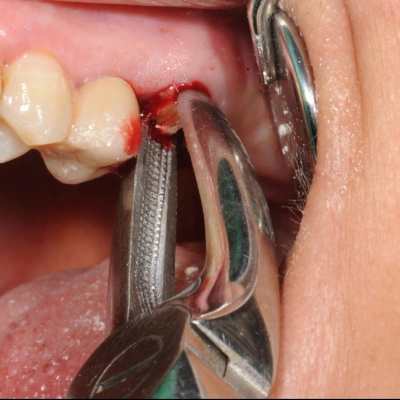 Precise surgical extraction for complex impacted tooth cases